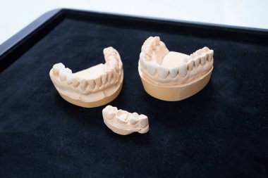 Ceramic teeth on a plaster model on a black background