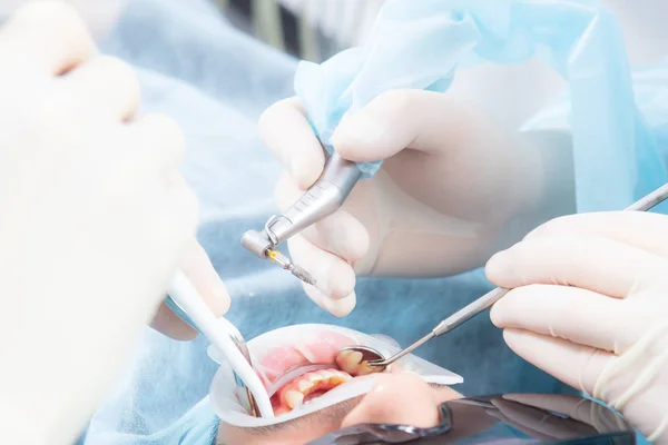 Uma ferramenta de implantação moderna é fixada em uma broca dentária. Fechar, foto macro . — Fotografia de Stock