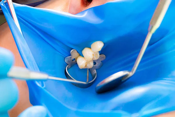 Närbild latexplatta utformad för att isolera tanden som ska behandlas från resten av munhålan under behandlingen. — Stockfoto
