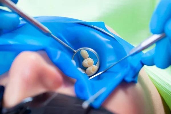 Närbild latexplatta utformad för att isolera tanden som ska behandlas från resten av munhålan under behandlingen. — Stockfoto
