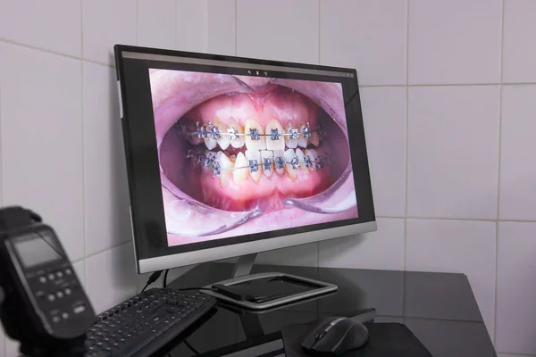 Zdjęcie szczęki z aparatem na monitorze komputera. Ortodoncja, protokół fotograficzny — Zdjęcie stockowe