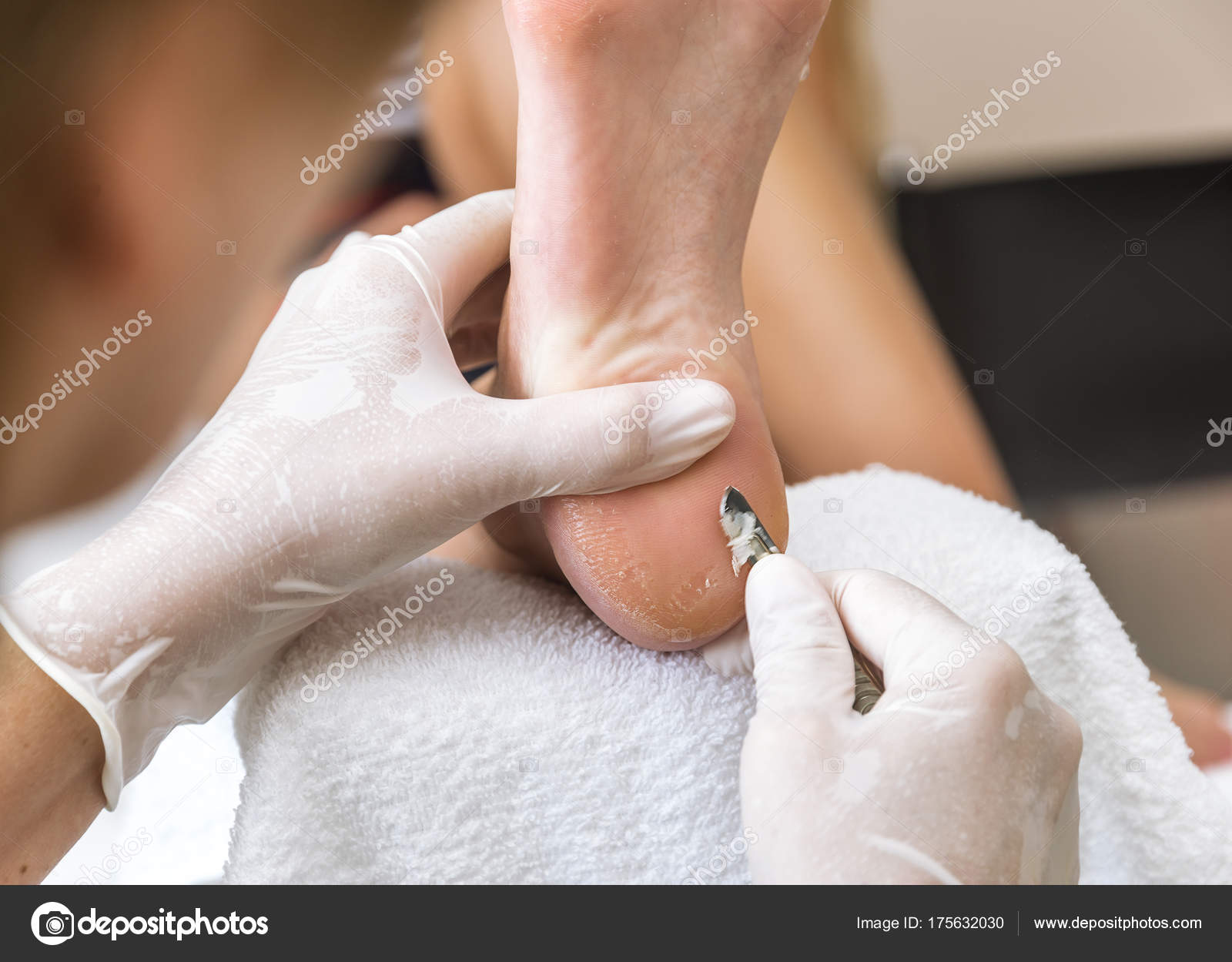 Chiropodist Removes Skin Wart Scalpel Sole Foot Woman Stock Photo by  ©hammett79 175632030