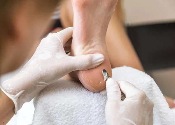 Chiropodist Quita Piel Una Verruga Con Bisturí Planta Del Pie —  Fotos de Stock