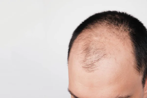 Male pattern hair loss problem concept. Young man losing hair on temples, close up. Space for text. Baldness, alopecia in males.