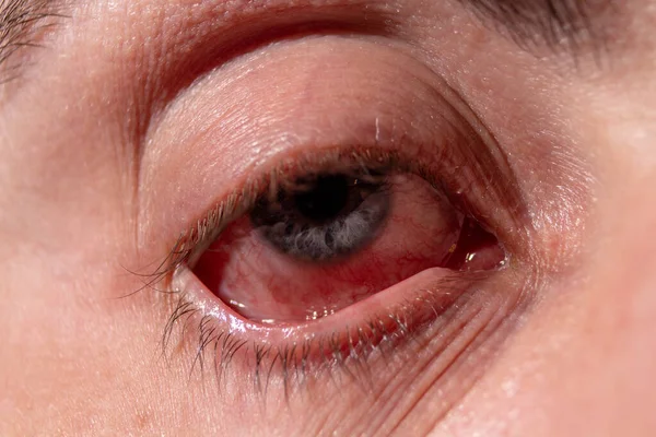 Se extrae un párpado de un ojo enfermo con venas inflamadas por infección. —  Fotos de Stock