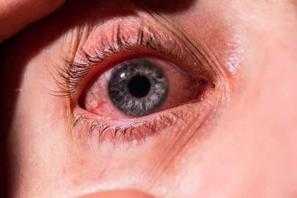 Se extrae un párpado de un ojo enfermo con venas inflamadas por infección. — Foto de Stock