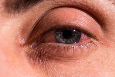 İltihap iltihaplı gözlerden çıkar. Yakın.