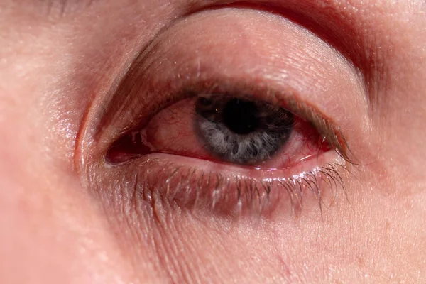 El pus surge de un ojo infectado. Cerca de —  Fotos de Stock
