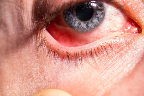 Een ooglid wordt uitgetrokken uit een ziek oog met ontstoken aderen van infectie — Stockfoto