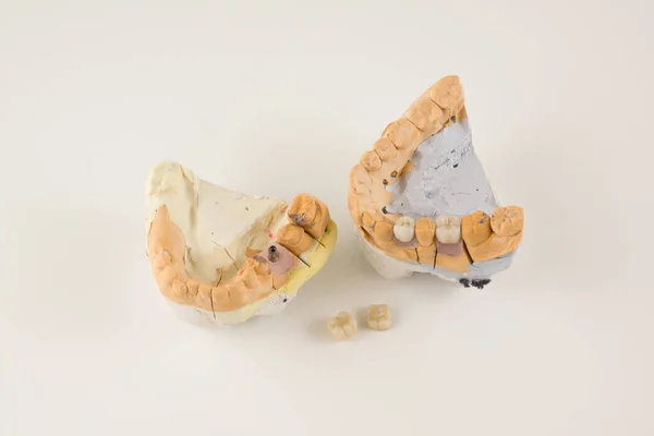 Производство зубного протеза — стоковое фото