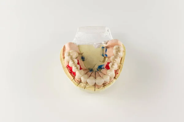 The denture made of ceramics located on plaster model — Stock Photo, Image