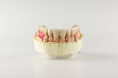 alçı model üzerinde bulunan seramik yapılmış takma diş