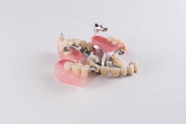 Seramik kron düzeltme ekleri ile toka protez