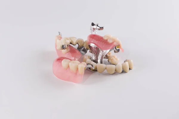 Clasp prosthesis with attachments fixing ceramic crowns — Stock Photo, Image