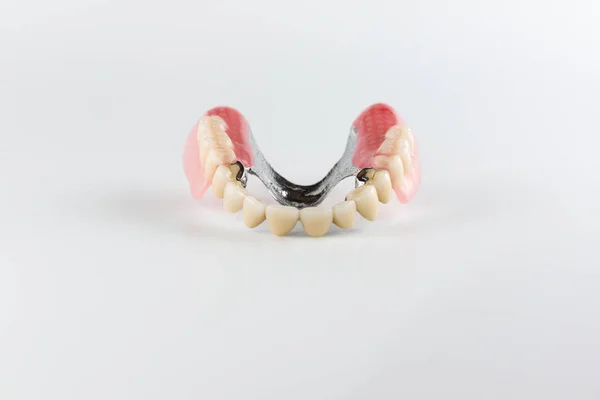 クラスプ義歯セラミック冠を固定の添付ファイル — ストック写真
