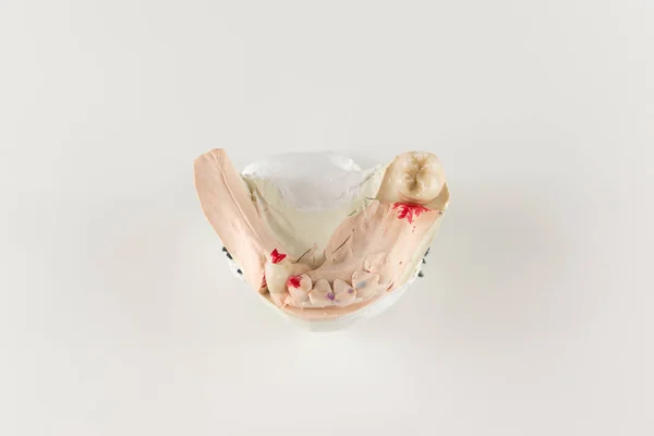 The denture made of ceramics located on plaster model — Stock Photo, Image