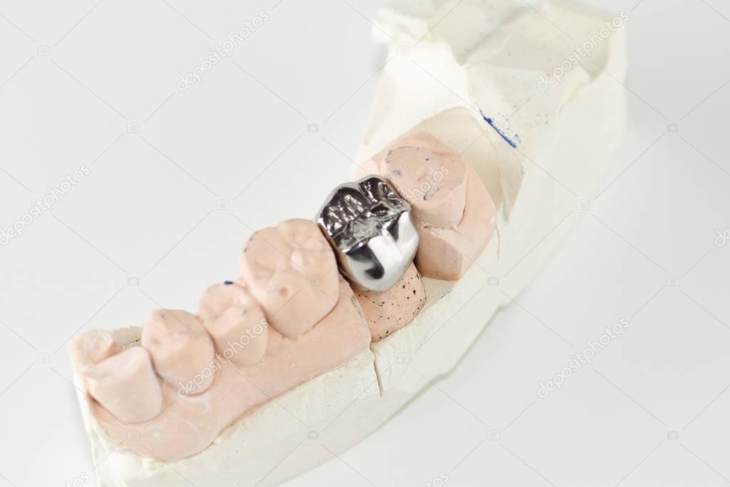 cast metal dental crown