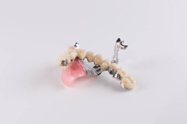 Seramik kron düzeltme ekleri ile toka protez