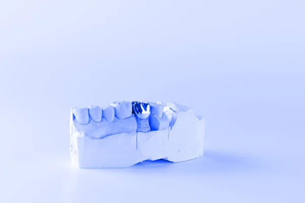 Corona dental de metal fundido — Foto de Stock