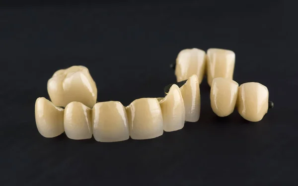 Coroas de dentes Cermet — Fotografia de Stock