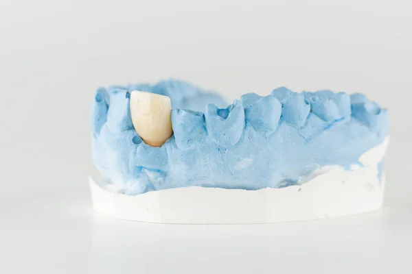 New dentures on a white background — Stock Photo, Image