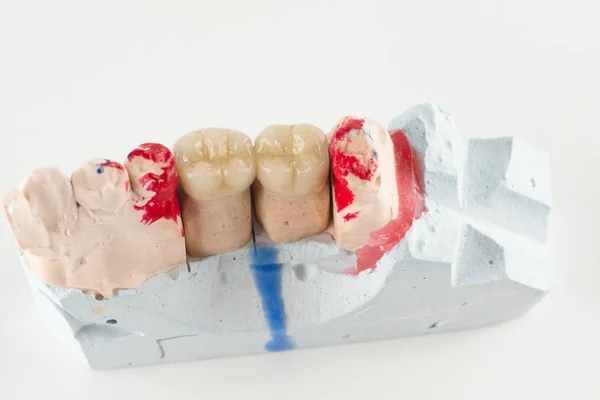 Ceramic crowns to try on a tooth model — Stock Photo, Image