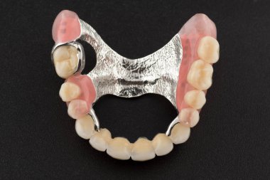 Kilit fiksasyon ile toka protez