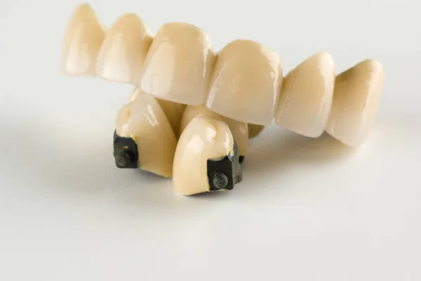 Corone dei denti cermet — Foto Stock