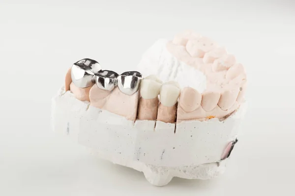 Überbrückter Zahnersatz — Stockfoto