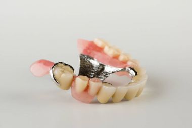 Kilit fiksasyon ile toka protez