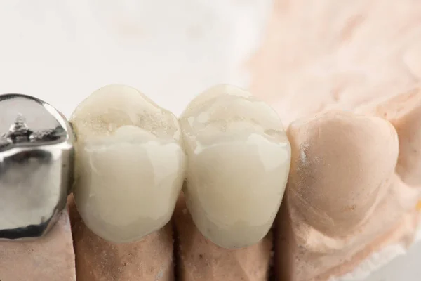 Bryggade tandproteser — Stockfoto