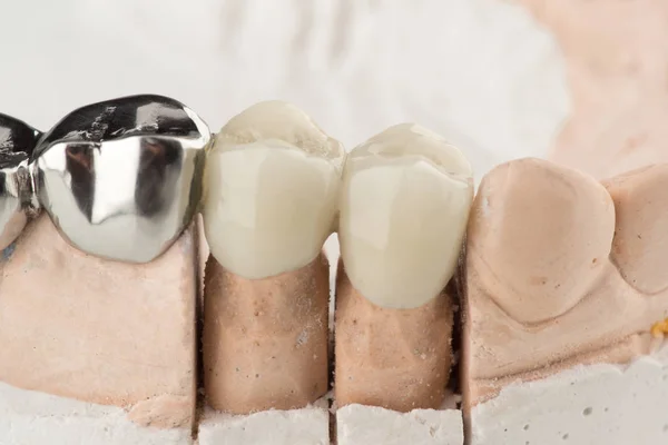 Próteses dentárias em ponte — Fotografia de Stock