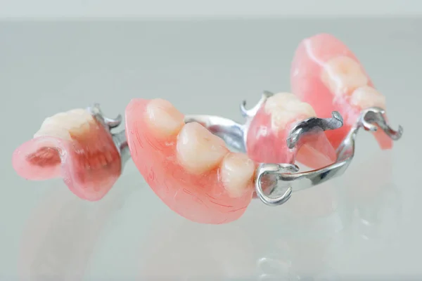 Clasp denture with a metal arc — Stock Photo, Image