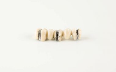 Seramik kitle takma diş hasar