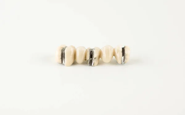 Пошкодження зубів від керамічної маси — стокове фото