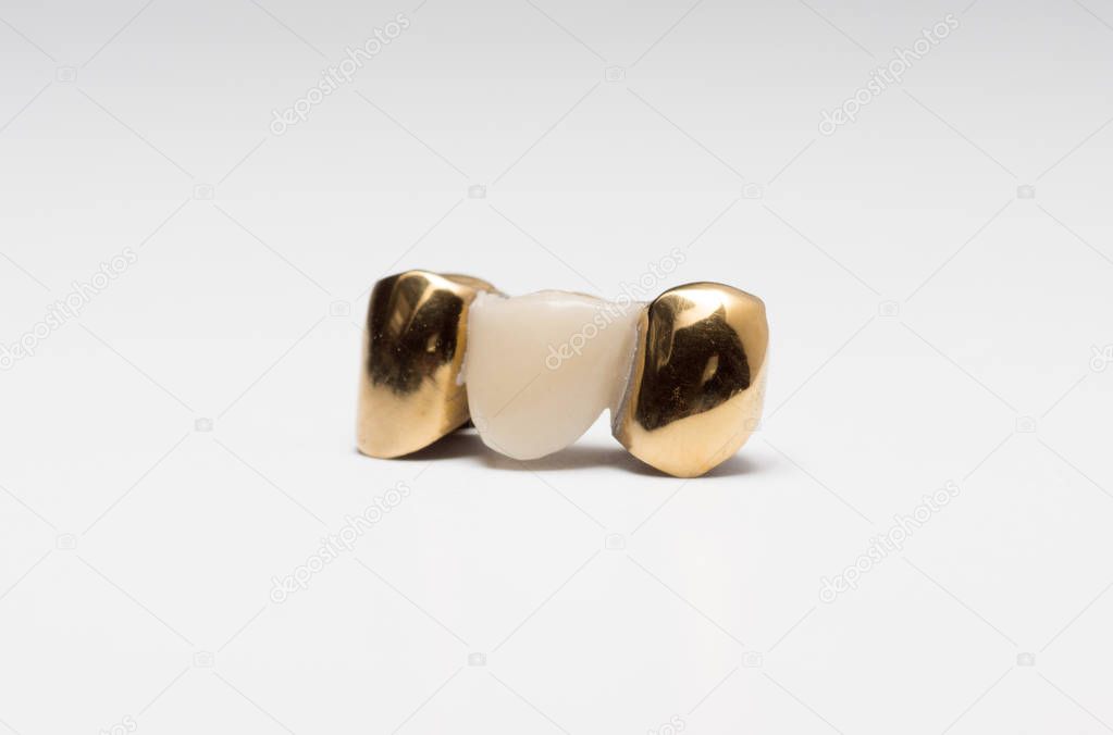 Artificial tooth crown