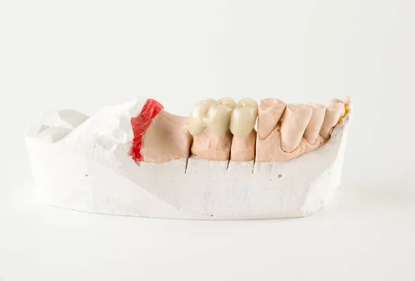 Dents de céramique — Photo
