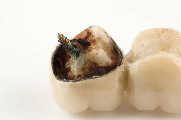Nova coroa dental — Fotografia de Stock