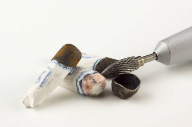 Damgalama tarafından elde edilen yapay diş kron