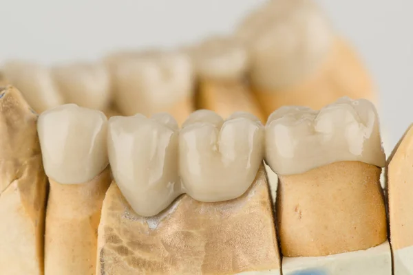 Puentes dentales cermet Fotos De Stock