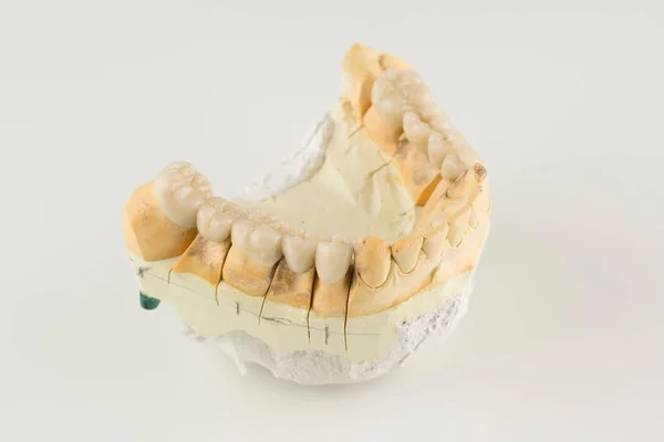 Cermet dental bridges — Stock Photo, Image