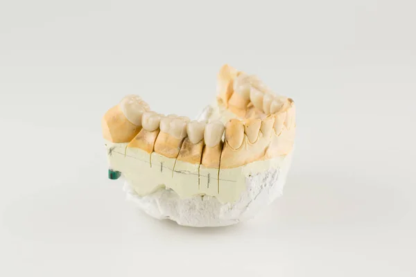 Cermet dental bridges — Stock Photo, Image