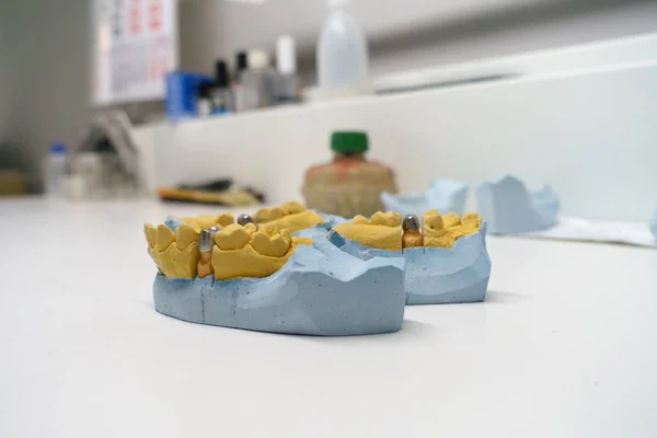 Dentista examina coroas dentárias artificiais em um modelo — Fotografia de Stock