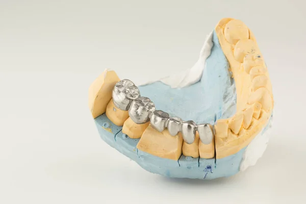 Corona artificiale dei denti — Foto Stock
