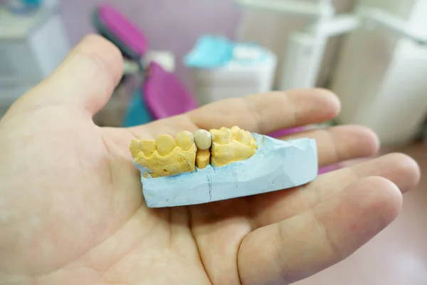 Coroa Dente Cerâmico Close Modelo Gesso Dentes Trabalho Mão Dentista — Fotografia de Stock