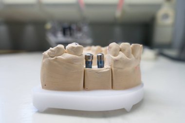Diş implantı olan insan çenesinin alçı taşı modeli