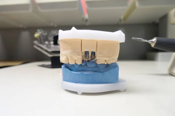 Modèle Gypse Mâchoire Humaine Avec Implants Dentaires — Photo