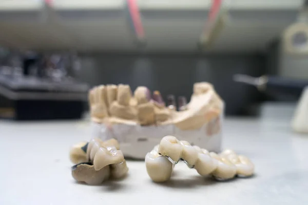 Modelo Gesso Mandíbula Humana Com Implantes Dentários — Fotografia de Stock