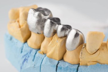 Diş kontrolü için yapay çelik kaplama.