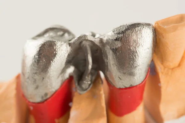 Puente Dental Artificial Acero Para Restauración Dentición — Foto de Stock